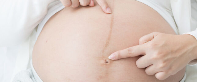 ما هو الفرق بين بطن الحامل والكرش