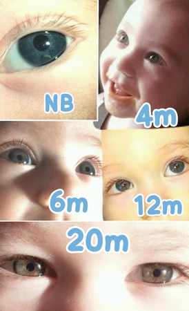 مراحل تغير لون عين الطفل بالصور