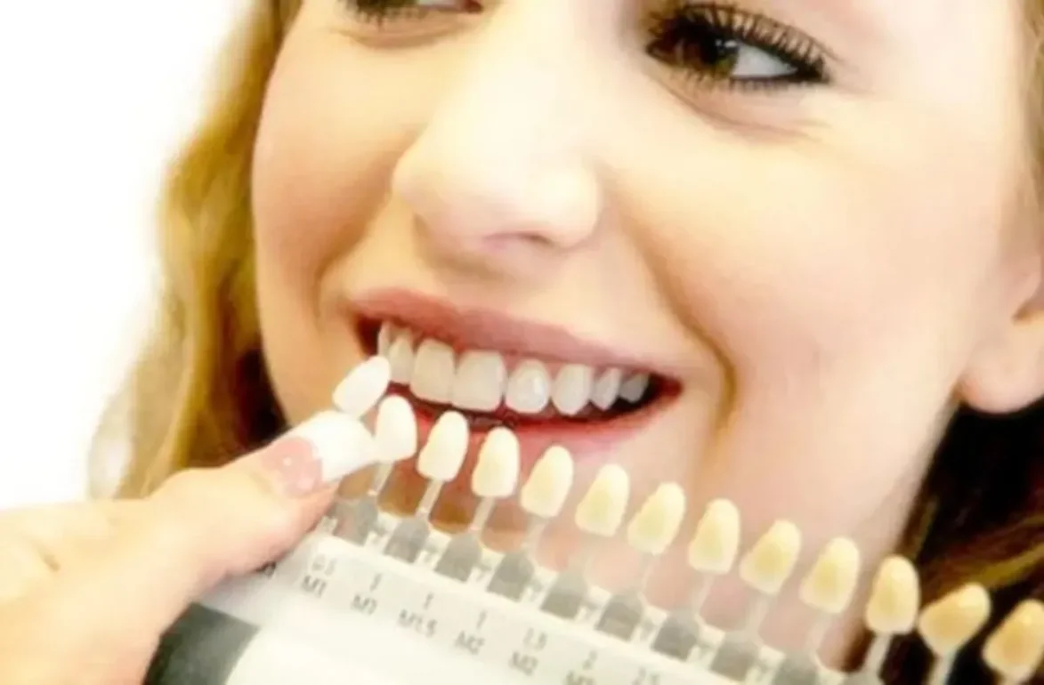 كتالوج درجات الوان اسنان الزيركون