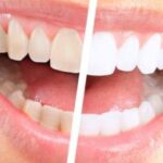 كم سعر تنظيف الاسنان من الجير في السعودية
